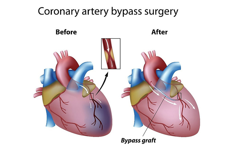 冠動脈バイパス手術のイメージ