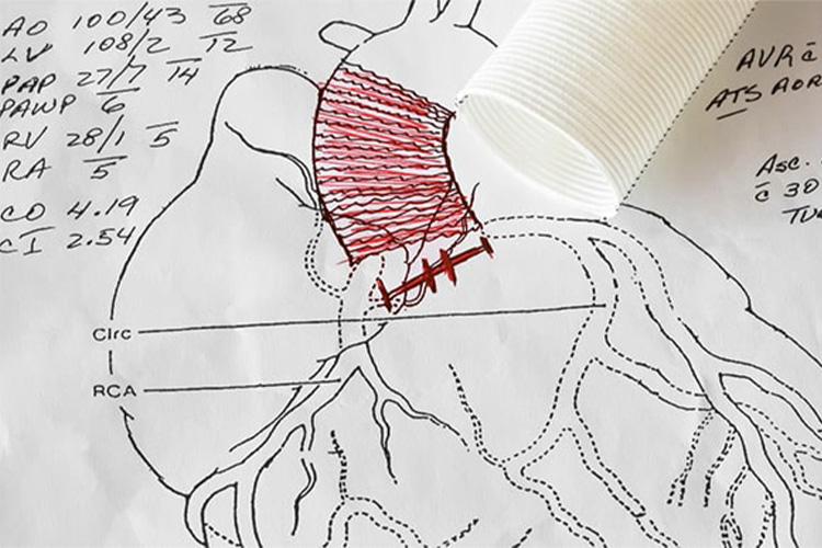 大動脈基部置換術のイメージ