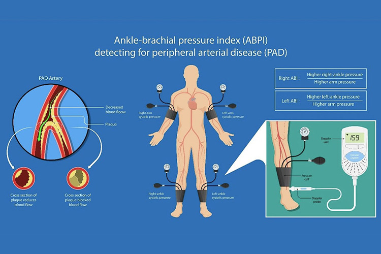 高血圧に合併する動脈硬化の検査のイメージ