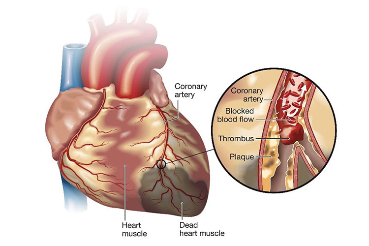 動脈硬化のイメージ