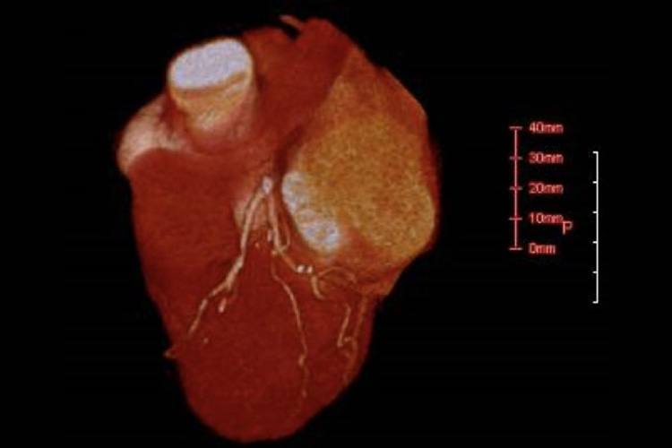 冠動脈CT検査のイメージ
