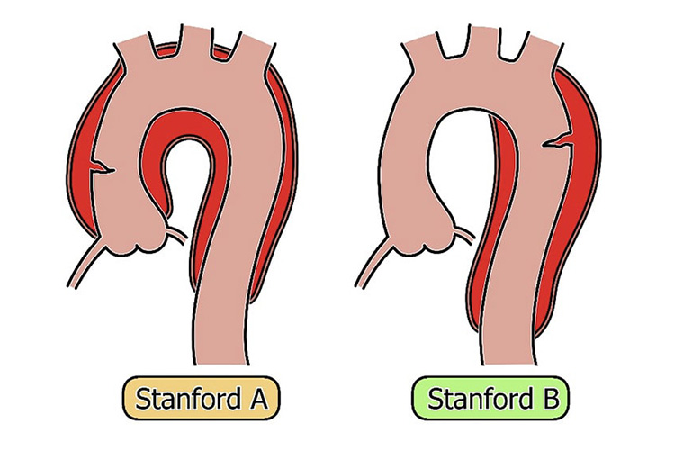 大動脈解離のイメージ