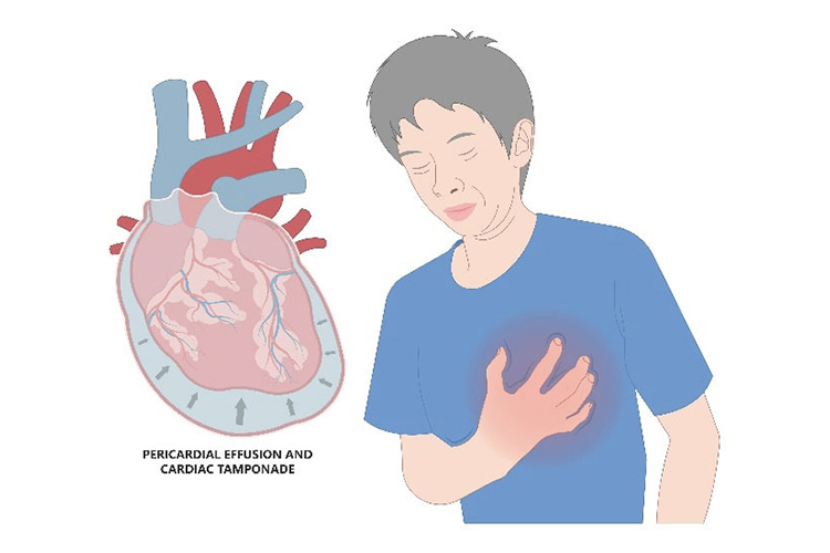 大動脈解離のイメージ
