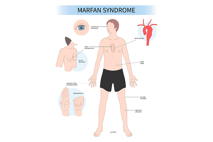 マルファン症候群のイメージ