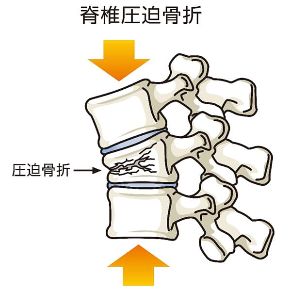 脊椎圧迫骨折のイメージ