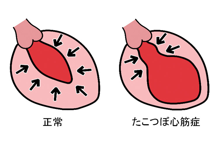 たこつぼ型心筋症のイメージ