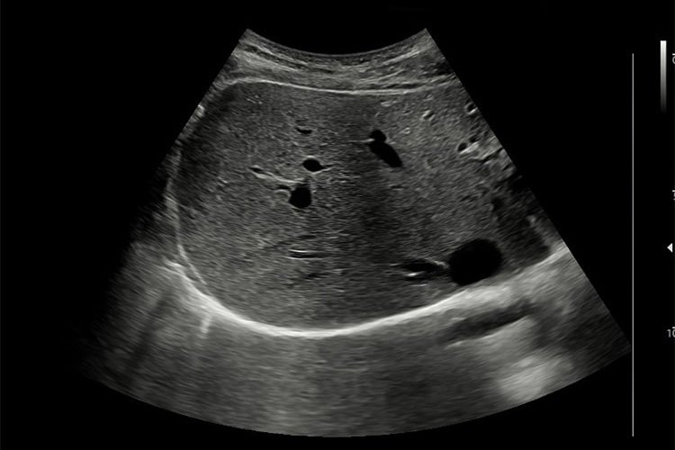 腹部超音波検査のイメージ