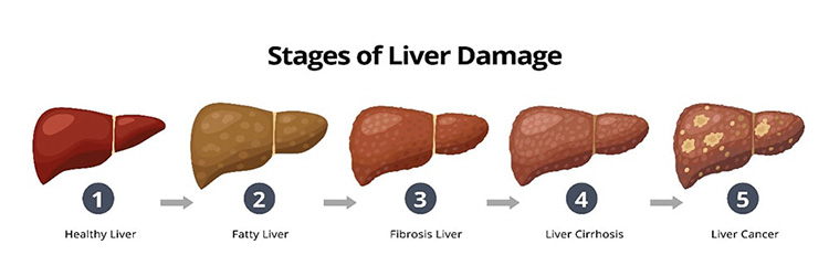 肝臓のステージ