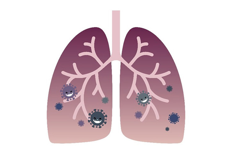 肺炎のイメージ