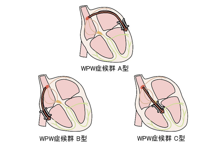 WPW症候群のイメージ