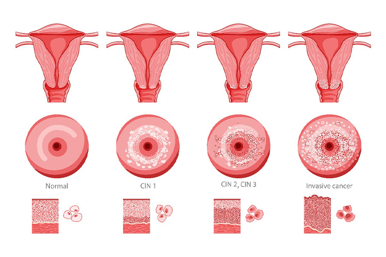 子宮頸がんのイメージ