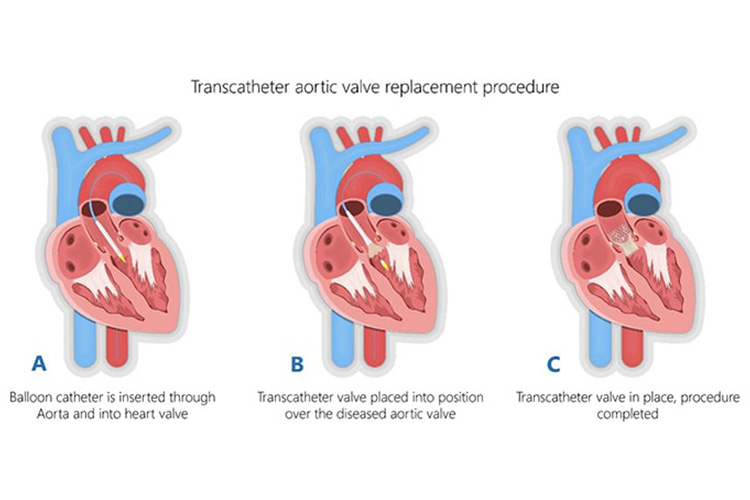 心臓弁膜症の治療のイメージ