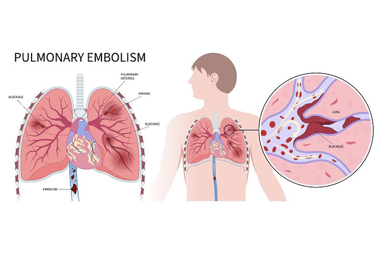 肺血栓塞栓症と深部静脈血栓症のイメージ