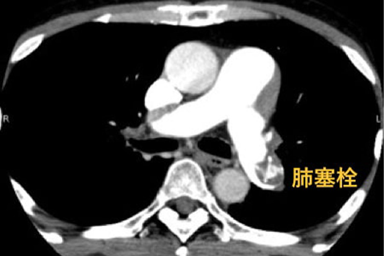 造影CT検査のイメージ