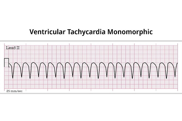 心室頻拍の波形のイメージ