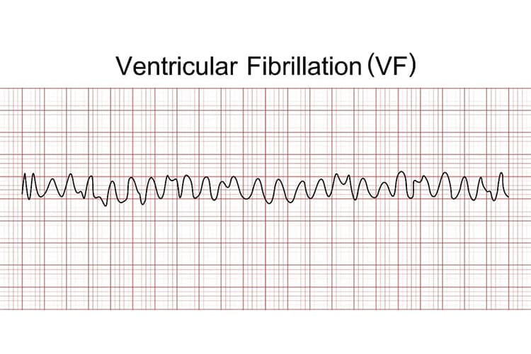心室細動の波形のイメージ